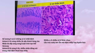 Số lượng ít và ở những vị trí nhất định
Antoni A là vùng nhiều tb xếp thành hàng rào
Nhân tb xếp song song/cuộn tròn tạo thể
Verocay
Antoni B là vùng ít tb, nhiều nhân đông vùi
trong chất đệm thoái hóa nhầy
Nhiều u ở nhiều vị trí khác nhau
Cấu trúc xoáy xen lẫn mô đệm nhầy hay hyalin hóa
 