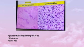 ngoài ra thành mạch trong U dày do
hiện tượng
Hyalin hóa
 