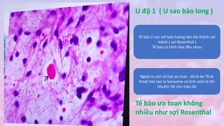 Tế bào 2 cực với bào tương kéo dài thành sợi
mảnh ( sợi Rosenthal )
Tế bào có hình thoi đều nhau
U độ 1 ( U sao bào long )
Ngoài ra còn có hạt ưa toan : đó là do Tb bị
thoái hóa tạo ra lysosome có tính acid và khi
nhuộm HE cho màu đỏ
Tế bào ưa toan không
nhiều như sợi Rosenthal
 