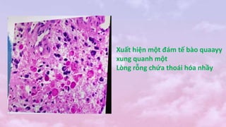 Xuất hiện một đám tế bào quaayy
xung quanh một
Lòng rỗng chứa thoái hóa nhầy
 