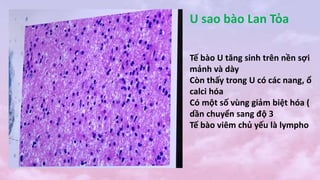 U sao bào Lan Tỏa
Tế bào U tăng sinh trên nền sợi
mảnh và dày
Còn thấy trong U có các nang, ổ
calci hóa
Có một số vùng giảm biệt hóa (
dần chuyển sang độ 3
Tế bào viêm chủ yếu là lympho
 