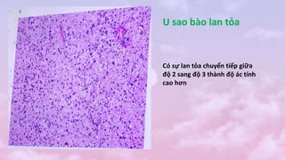U sao bào lan tỏa
Có sự lan tỏa chuyển tiếp giữa
độ 2 sang độ 3 thành độ ác tính
cao hơn
 