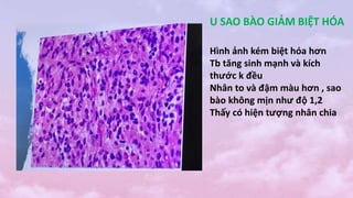 U SAO BÀO GIẢM BIỆT HÓA
Hình ảnh kém biệt hóa hơn
Tb tăng sinh mạnh và kích
thước k đều
Nhân to và đậm màu hơn , sao
bào không mịn như độ 1,2
Thấy có hiện tượng nhân chia
 