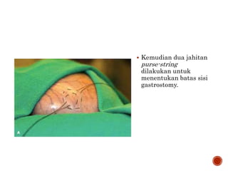  Kemudian dua jahitan
purse-string
dilakukan untuk
menentukan batas sisi
gastrostomy.
 