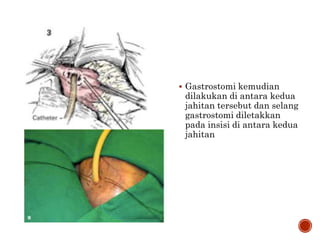  Gastrostomi kemudian
dilakukan di antara kedua
jahitan tersebut dan selang
gastrostomi diletakkan
pada insisi di antara kedua
jahitan
 