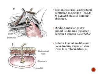  Bagian eksternal gastrostomi
kemudian disisipkan (inside
to outside) melalui dinding
abdomen.
 Dinding anterior gaster
dijahit ke dinding abdomen
dengan 4 jahitan absorbable
 Kateter kemudian difiksasi
pada dinding abdomen dan
insisi laparotomi ditutup.
 