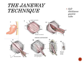  full-
thickness
gastric
tube
 