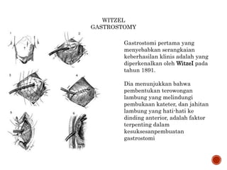 WITZEL
GASTROSTOMY
Gastrostomi pertama yang
menyebabkan serangkaian
keberhasilan klinis adalah yang
diperkenalkan oleh WitzeI pada
tahun 1891.
Dia menunjukkan bahwa
pembentukan terowongan
lambung yang melindungi
pembukaan kateter, dan jahitan
lambung yang hati-hati ke
dinding anterior, adalah faktor
terpenting dalam
kesuksesanpembuatan
gastrostomi
 