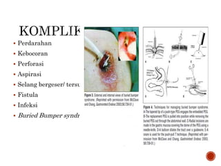  Perdarahan
 Kebocoran
 Perforasi
 Aspirasi
 Selang bergeser/ tersumbat
 Fistula
 Infeksi
 Buried Bumper syndrome
 