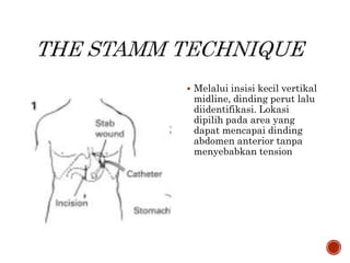  Melalui insisi kecil vertikal
midline, dinding perut lalu
diidentifikasi. Lokasi
dipilih pada area yang
dapat mencapai dinding
abdomen anterior tanpa
menyebabkan tension
 