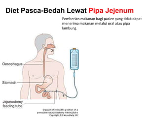 Pemberian makanan bagi pasien yang tidak dapat
menerima makanan melalui oral atau pipa
lambung.
Diet Pasca-Bedah Lewat Pipa Jejenum
 