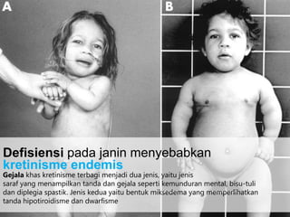 Gejala khas kretinisme terbagi menjadi dua jenis, yaitu jenis
saraf yang menampilkan tanda dan gejala seperti kemunduran mental, bisu-tuli
dan diplegia spastik. Jenis kedua yaitu bentuk miksedema yang memperlihatkan
tanda hipotiroidisme dan dwarfisme
Defisiensi pada janin menyebabkan
kretinisme endemis
 