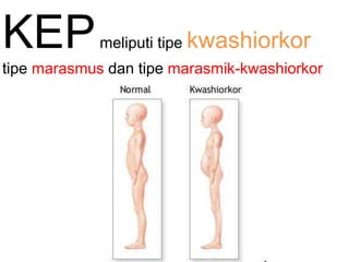 KEPmeliputi tipe kwashiorkor
tipe marasmus dan tipe marasmik-kwashiorkor
 