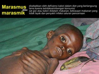 disebabkan oleh defisiensi kalori dalam diet yang berlangsung
lama karena ketidakseimbangan konsumsi
zat gizi atau kalori didalam makanan, kebiasaan makanan yang
tidak layak dan penyakit infeksi saluran pencernaan
Marasmus
marasmik
atau
 
