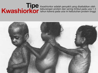Kwashiorkor adalah penyakit yang disebabkan oleh
kekurangan protein dan sering timbul pada usia 1-3
tahun karena pada usia ini kebutuhan protein tinggi
Tipe
Kwashiorkor
 