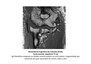 Ressonância magnética do cotovelo direito
Corte coronal, sequência T1 (a)
(a) Osteófitos marginais no côndilo umeral medial e na ulna (setas), irregularidade dos
contornos do osso subcondral do úmero, rádio e ulna
 