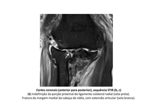 Cortes coronais (anterior para posterior), sequência STIR (b, c)
(b) Indefinição da porção proximal do ligamento colateral radial (seta preta).
Fratura da margem medial da cabeça do rádio, com extensão articular (seta branca).
 