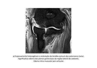c) Espessamento heterogêneo e ondulação do tendão comum dos extensores (seta).
Significativo edema dos planos gordurosos da região lateral do cotovelo.
Edema intra-muscular peri-articular
 
