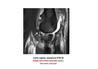 Corte sagital, sequência STIR (f)
Corpo livre intra-articular (seta).
Derrame articular
 