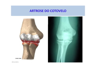 09/12/2015
ARTROSE DO COTOVELO
 