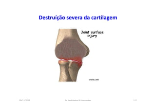 09/12/2015 Dr. José Heitor M. Fernandes 122
Destruíção severa da cartilagem
 