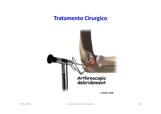 09/12/2015 Dr. José Heitor M. Fernandes 126
Tratamento Cirurgico
 