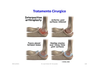 09/12/2015 Dr. José Heitor M. Fernandes 128
Tratamento Cirurgico
 