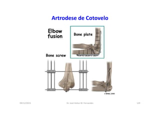 09/12/2015 Dr. José Heitor M. Fernandes 129
Artrodese de Cotovelo
 