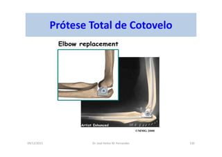 09/12/2015 Dr. José Heitor M. Fernandes 130
Prótese Total de Cotovelo
 