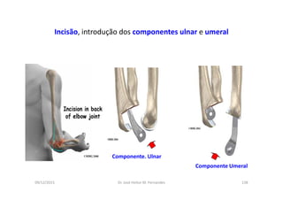 09/12/2015 Dr. José Heitor M. Fernandes 138
Incisão, introdução dos componentes ulnar e umeral
Componente. Ulnar
Componente Umeral
 