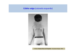 Cúbito valgo (cotovelo esquerdo)
Reider, O Exame Físico em Ortopedia – Guanabara Koogan -2001
 