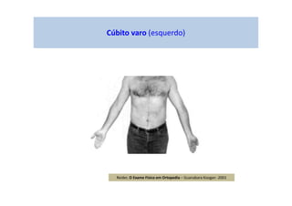 Cúbito varo (esquerdo)
Reider, O Exame Físico em Ortopedia – Guanabara Koogan -2001
 