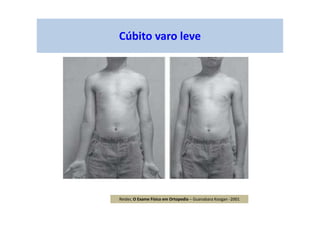 Cúbito varo leve
Reider, O Exame Físico em Ortopedia – Guanabara Koogan -2001
 