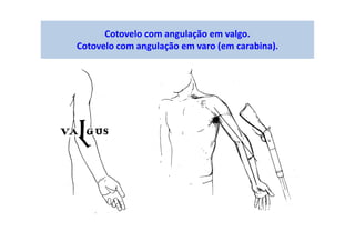 Cotovelo com angulação em valgo.
Cotovelo com angulação em varo (em carabina).
 