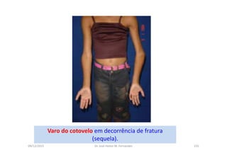 09/12/2015 Dr. José Heitor M. Fernandes 155
Varo do cotovelo em decorrência de fratura
(sequela).
 
