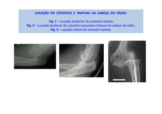 LUXAÇÃO DO COTOVELO E FRATURA DA CABEÇA DO RÁDIO:
Fig. 1 – Luxação posterior do cotovelo isolada.
Fig. 2 – Luxação posterior do cotovelo associada à fratura da cabeça do rádio.
Fig. 3 – Luxação lateral do cotovelo isolada.
 