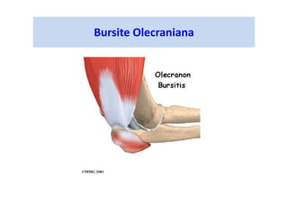 Bursite Olecraniana
 