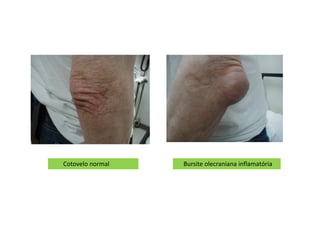 Bursite olecraniana inflamatóriaCotovelo normal
 