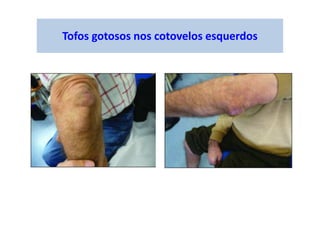 Tofos gotosos nos cotovelos esquerdos
 