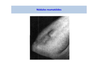Nódulos reumatóides
 