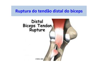 Ruptura do tendão distal do bíceps
 