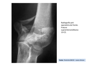 Fonte: Portal da SBCOC – casos clínicos
Radiografia pré-
operatória de frente.
Fratura
supraintercondileana
13-C2.
 