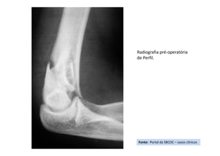 Fonte: Portal da SBCOC – casos clínicos
Radiografia pré-operatória
de Perfil.
 
