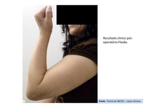 Fonte: Portal da SBCOC – casos clínicos
Resultado clínico pós-
operatório Flexão.
 