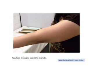 Fonte: Portal da SBCOC – casos clínicos
Resultado clínico pós-operatório Extensão.
 