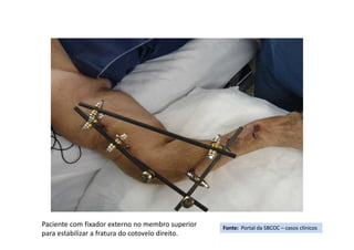 Fonte: Portal da SBCOC – casos clínicos
Paciente com fixador externo no membro superior
para estabilizar a fratura do cotovelo direito.
 