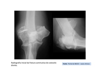Fonte: Portal da SBCOC – casos clínicos
Radiografia inicial da fratura cominutiva do cotovelo
direito.
 