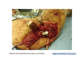 Fonte: Portal da SBCOC – casos clínicosAspecto intra-operatório da prótese no cotovelo.
 