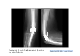 Fonte: Portal da SBCOC – casos clínicos
Radiografia de controle pós-operatório da prótese
do cotovelo direito.
 