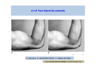 A e B Face lateral do cotovelo
A. olécrano; B. epicôndilo lateral; C. cabeça do rádio.
A
Reider, O Exame Físico em Ortopedia – Guanabara Koogan -2001
 